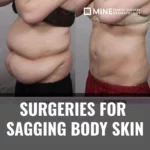 Tummy tuck and other surgeries for sagging body skin after weight loss — before and after results at Mine Clinic Seoul Korea.