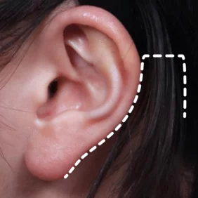 Close-up of the area behind the ear with a white dotted line marking the post-auricular incision site used in Zone ③ jawline lifting surgery at Mine Clinic Seoul, Korea.