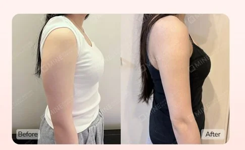 Before and after Arm Liposuction results at Mine Clinic Seoul Korea — slimmer, sculpted upper arm contour.