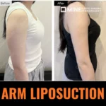 Korean Arm Liposuction before and after transformation at Mine Clinic Gangnam Seoul.