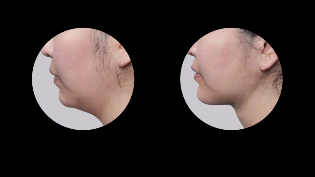Double chin surgery ultrasound guided treatment before and after side profile results at Mine Clinic Seoul Korea.
