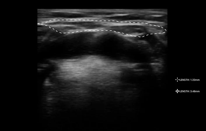 Double chin surgery ultrasound analysis outlining submental fat layer for precise pre-operative planning at Mine Clinic Korea.