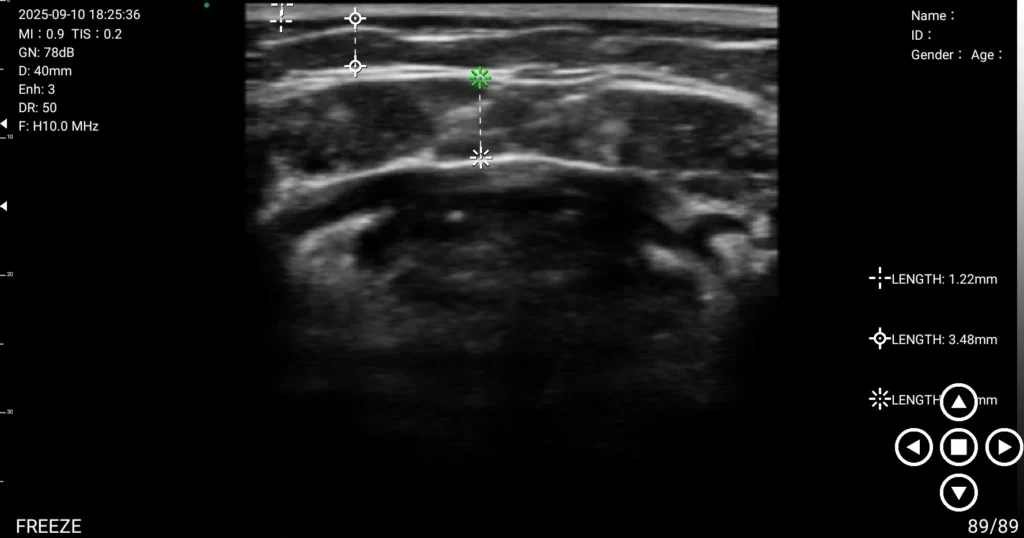 Double chin surgery ultrasound consultation at Mine Clinic Seoul measuring submental fat layer thickness (1.22mm and 3.48mm) before liposuction.