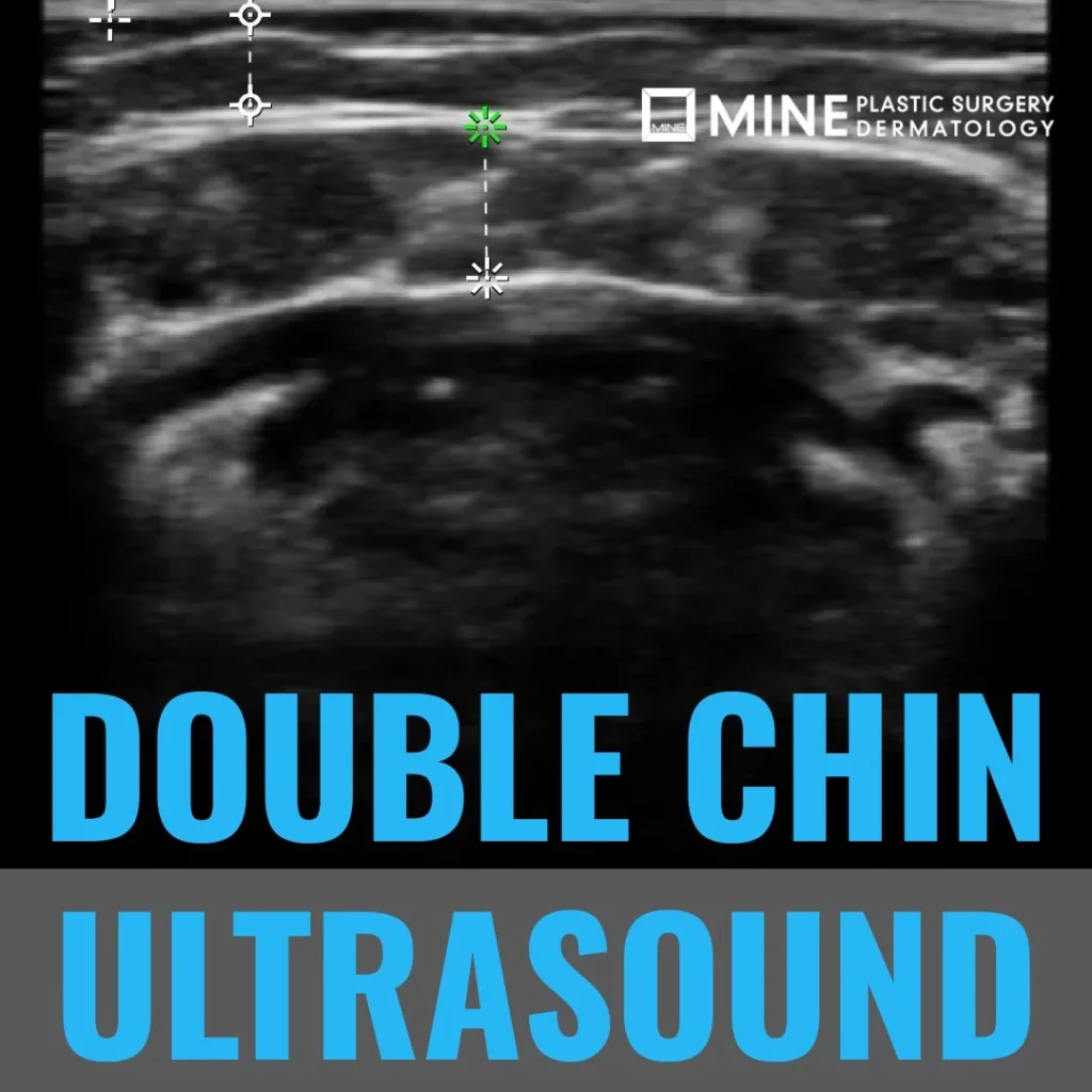 Double chin surgery ultrasound consultation blog cover featuring submental fat layer scan at Mine Clinic Plastic Surgery Dermatology Seoul.