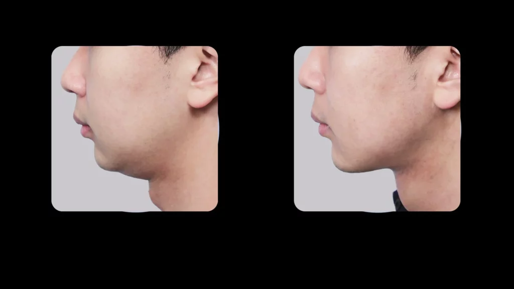 Male double chin surgery ultrasound guided treatment before and after side profile results at Mine Clinic Seoul Korea.