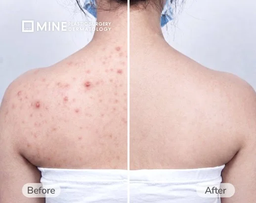 Before and after body acne treatment at Mine Clinic Seoul — significant clearing of back acne (bacne) after dermatology program including Aladdin Peel and Black Peel.