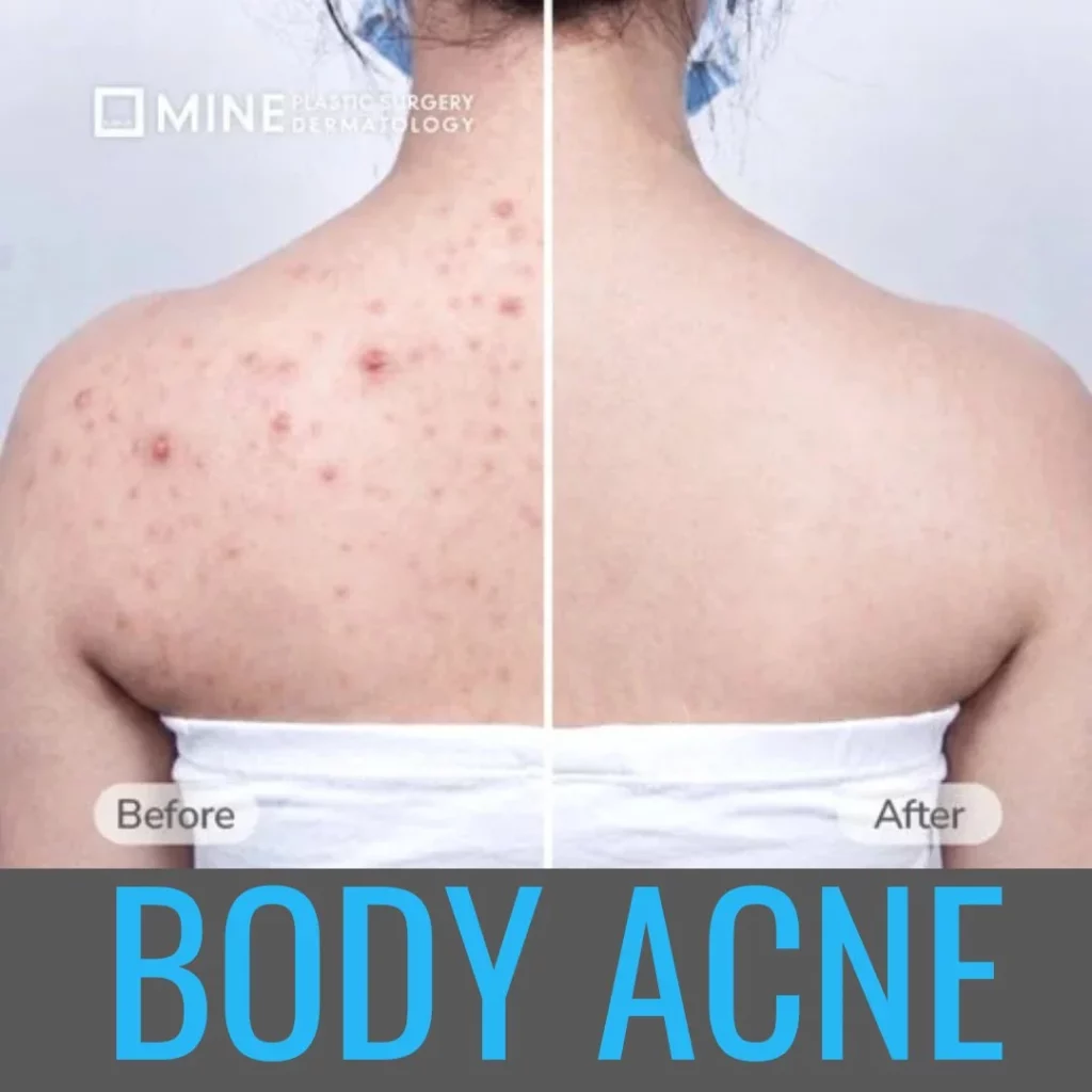 Mine Clinic Seoul body acne treatment before and after — dramatic clearing of severe back acne (bacne) following dermatology program with Aladdin Peel and Black Peel in Korea.
