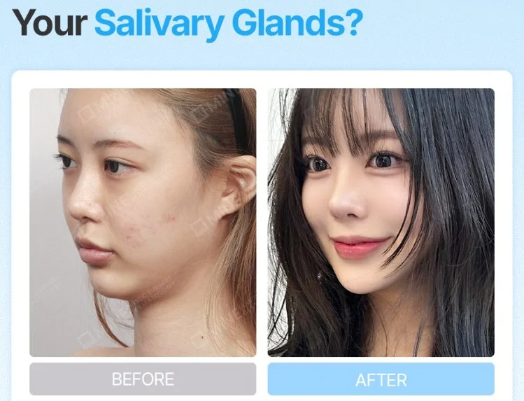 Before and after results of salivary gland reduction at Mine Clinic Seoul, showing a slimmer, more defined jawline — knowing the foods to avoid after salivary gland reduction helps maintain these results..