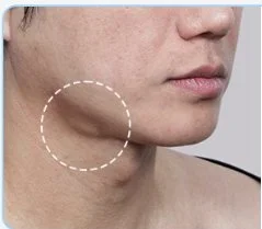 Profile view highlighting an enlarged submandibular salivary gland along the lower jawline, the target area for salivary gland reduction at Mine Clinic Seoul.