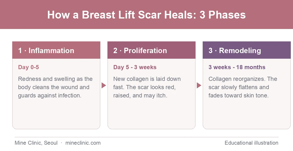 Three phases of breast lift scar healing: inflammation, proliferation, and remodeling, with their typical timelines.
