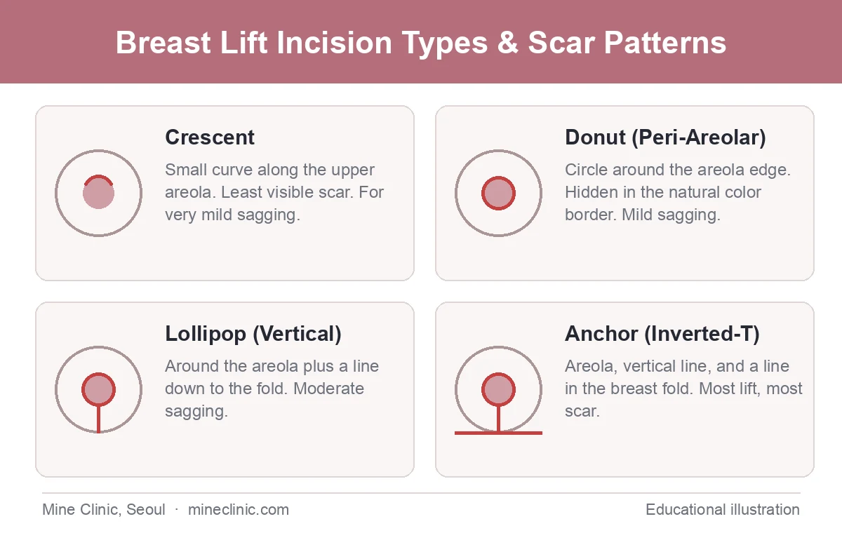Educational diagram of four breast lift incision types — crescent, donut or peri-areolar, lollipop or vertical, and anchor or inverted-T — showing how far each pattern extends around the areola and toward the breast fold.