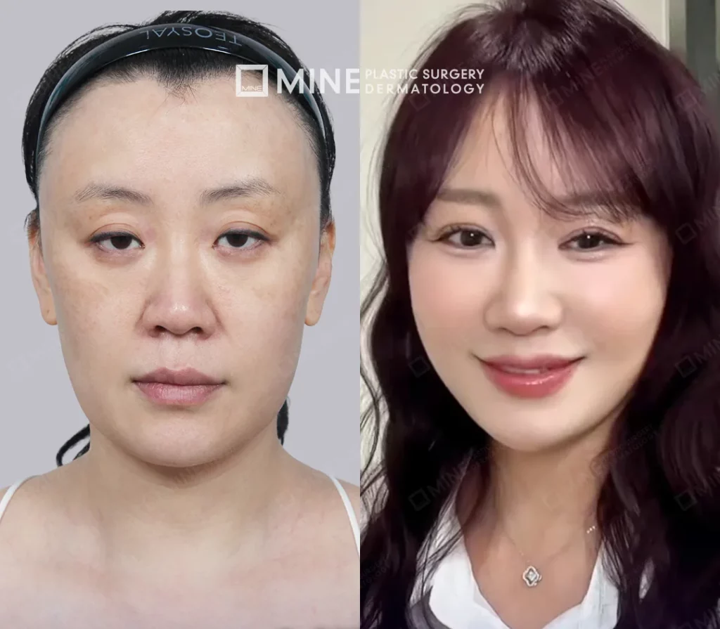 Deep plane facelift before and after at Mine Clinic Seoul Korea.
