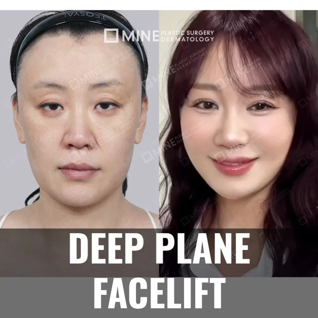 Deep plane facelift before and after results at Mine Clinic Seoul Korea.