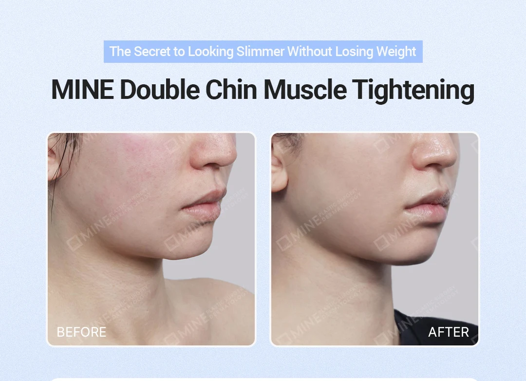 Double chin fat removal before and after at MINE Clinic showing a slimmer, more defined jawline