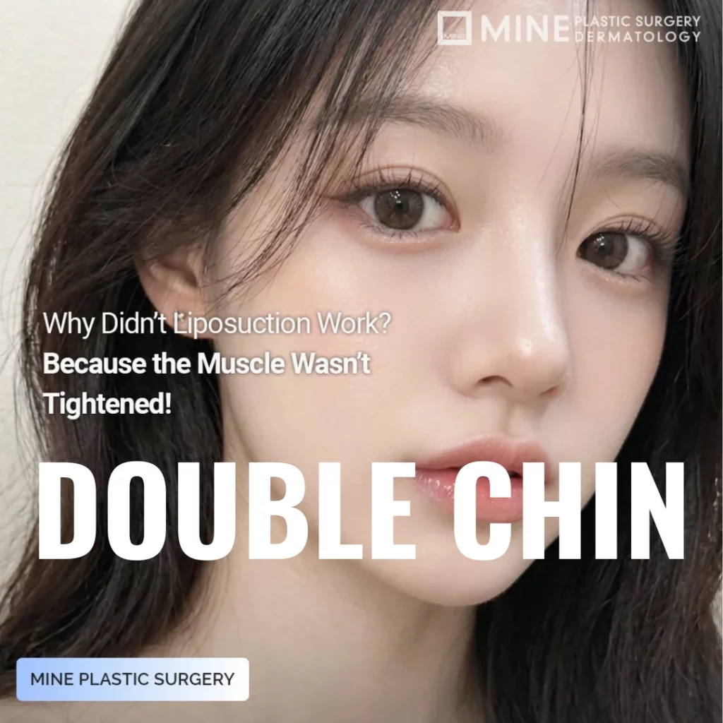 Double Chin Surgery at Mine Clinic Seoul — Korean woman with a slim, defined jawline, with the message that liposuction alone didn't work because the muscle wasn't tightened.