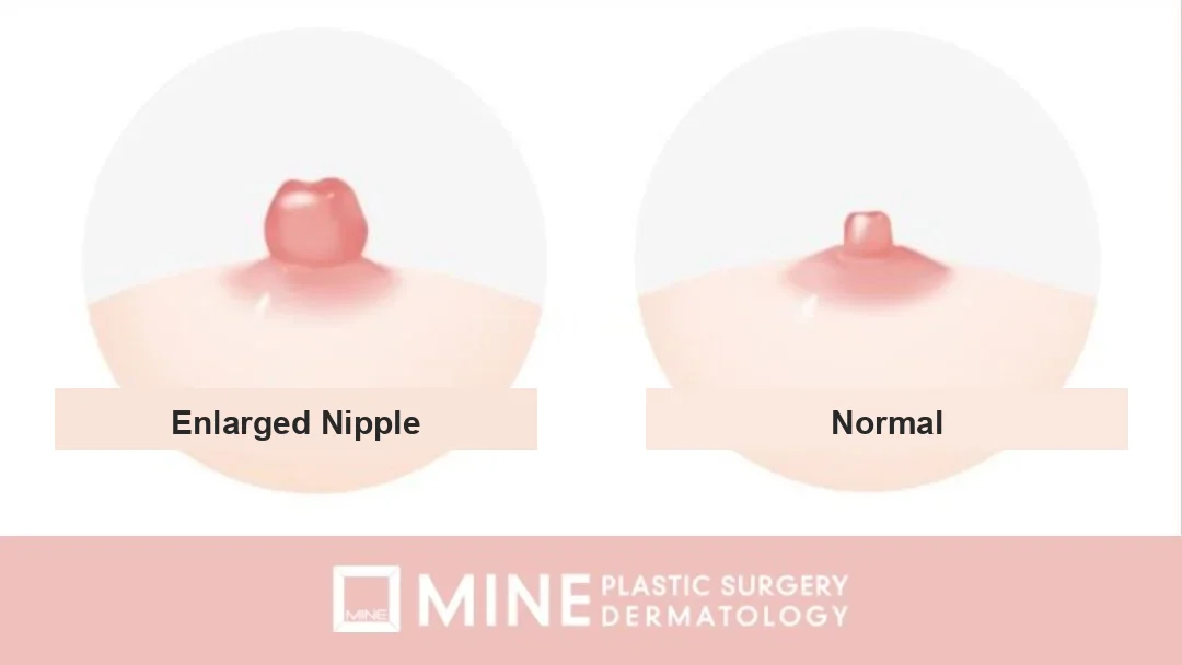 Comparison of enlarged nipple versus normal nipple size for nipple reduction surgery Korea
