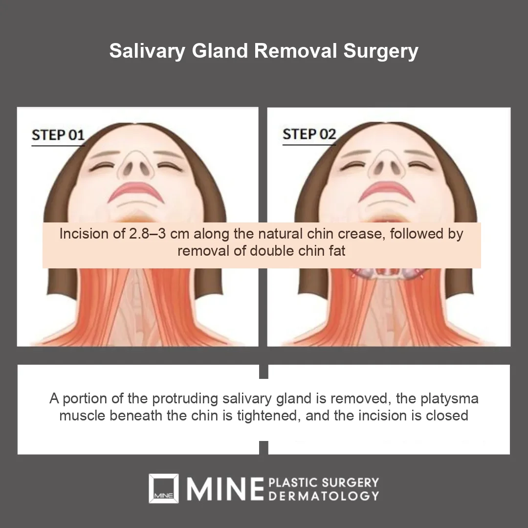 Submandibular gland partial resection surgery steps — submental incision approach for salivary gland botox not working cases at MINE Plastic Surgery