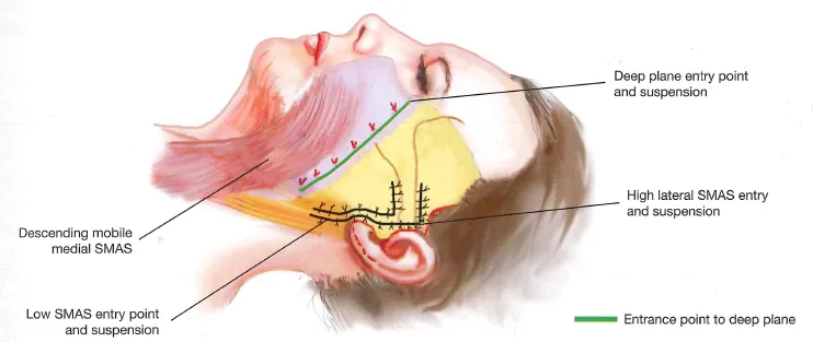 Deep plane facelift vs SMAS technique comparison surgical illustration — entry points and suspension vectors