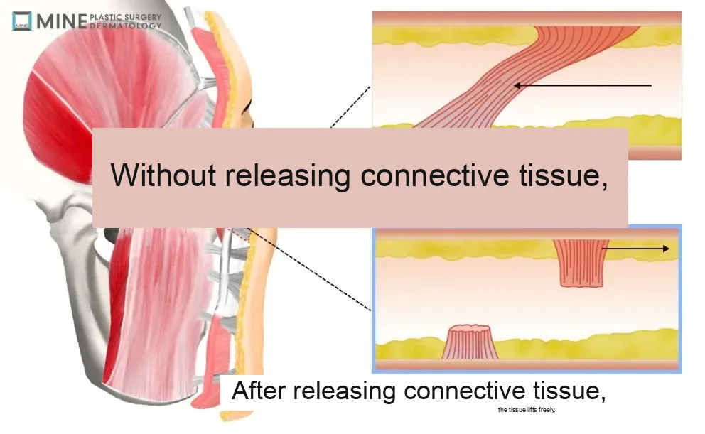 Deep plane facelift recovery — retaining ligament release diagram showing SMAS connective tissue before and after