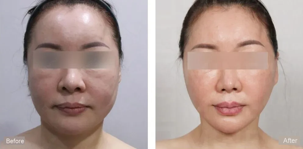 Facelift results before and after, showing visible rejuvenation.