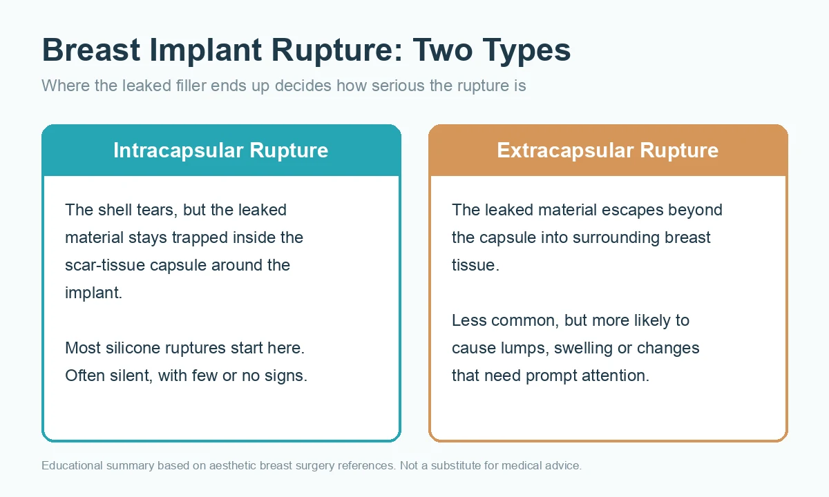 Diagram comparing intracapsular and extracapsular breast implant rupture