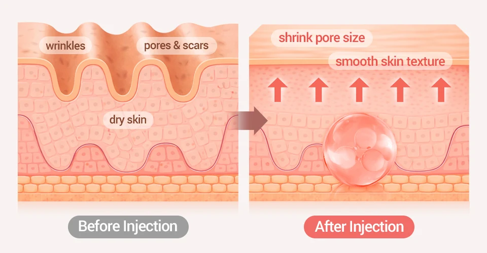 Re20 effect before and after diagram showing smoother skin texture, shrunken pore size.