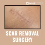 Scar Revision Surgery featured banner from Mine Clinic Seoul showing a widened surgical scar before treatment.