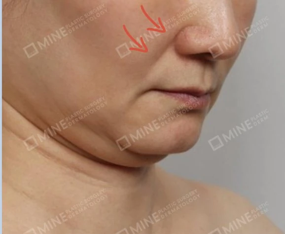 Deep smile line and face sagging along the jawline, a candidate for mini facelift treatment at Mine Clinic Seoul.