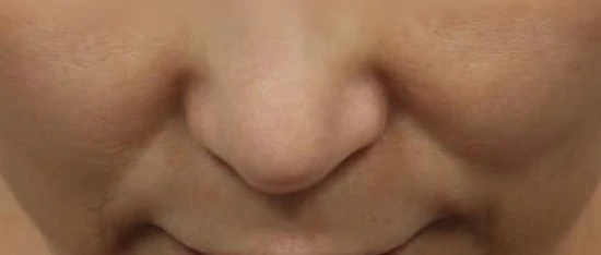 Sunken nasolabial folds and smile lines from volume loss, treated with filler or fat grafting at Mine Clinic Seoul.