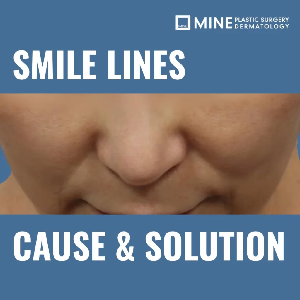 Smile lines cause and solution guide showing nasolabial folds and face sagging, mini facelift at Mine Clinic Seoul.