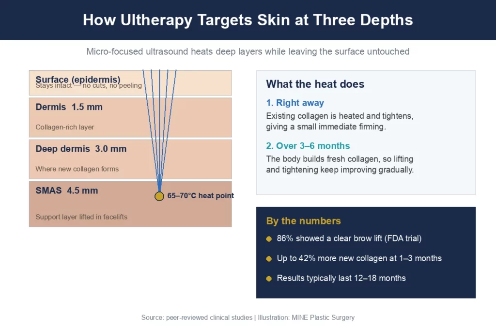 Diagram showing how Ultherapy micro-focused ultrasound heats the dermis and SMAS layer at 1.5mm, 3.0mm and 4.5mm depths