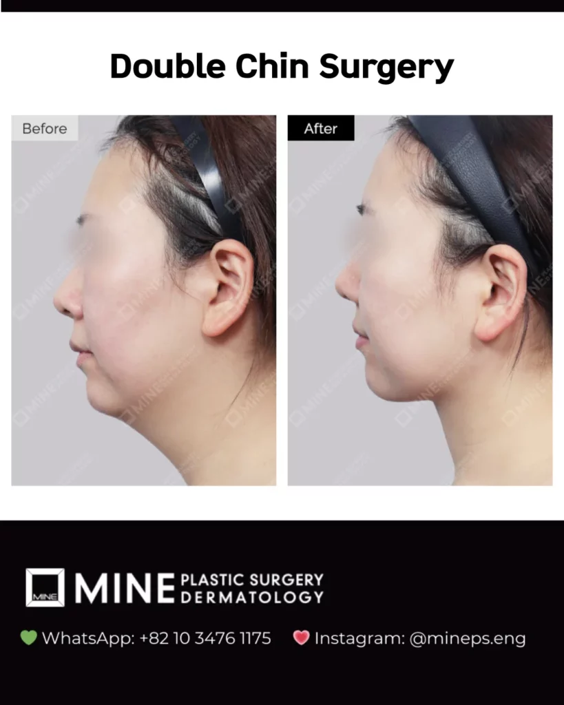 Double chin before and after side profile of a Mine Clinic patient in Seoul showing a sharper jawline and a clearly defined chin-to-neck angle.
