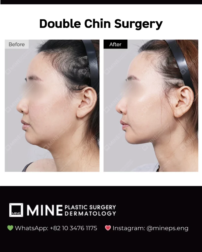 Double chin surgery before and after in Korea showing reduced submental fullness and a visible jawline running from the chin to the ear.