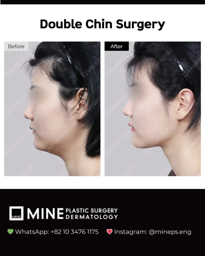 Double chin before and after result at Mine Clinic Gangnam showing a smoother neck contour on the side profile.