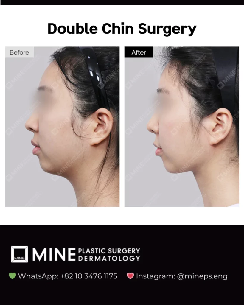 Double chin before and after photo of a female patient in Seoul with improved chin and neck border definition.