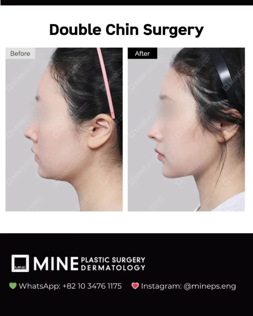 Double chin before and after case at Mine Clinic Korea with a continuous jawline shadow visible after surgery.