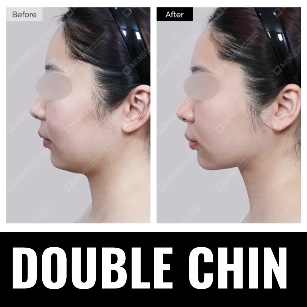 Double chin before and after results at Mine Clinic Seoul showing submental fat reduction and improved jawline definition.