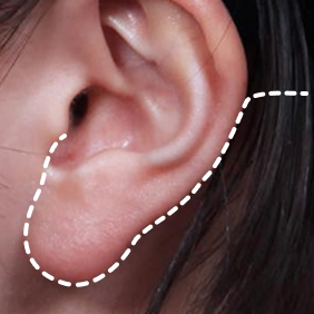 Facelift and neck lift surgical approach: discreet incision line around the ear