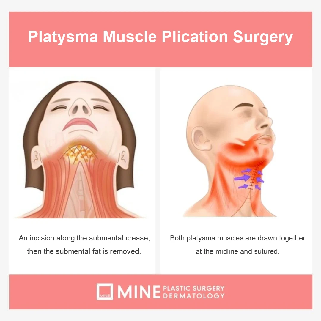 Platysmaplasty illustration showing tightening of the platysma muscle during neck lift surgery