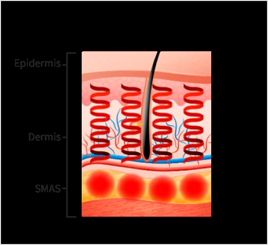 How Ultherapy in Korea targets the SMAS layer with microfocused ultrasound through the skin layers