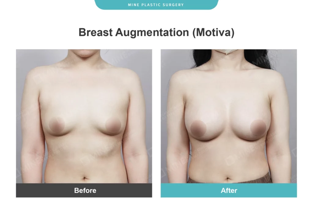 fat transfer breast augmentation before and after front view - Motiva