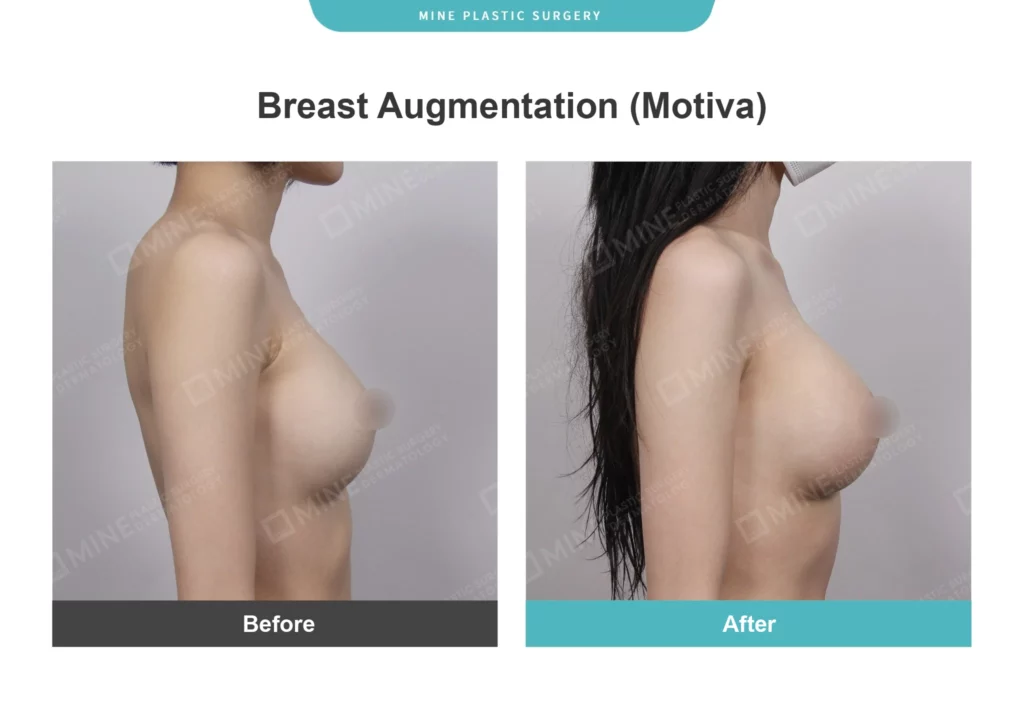Side profile comparison before and after fat transfer breast augmentation, showing subtle increase in breast volume and natural contour using autologous fat.