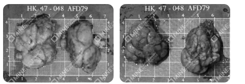 Actual excised salivary gland specimens from salivary gland reduction patients at MINE Clinic Korea, photographed on a centimeter measuring grid.