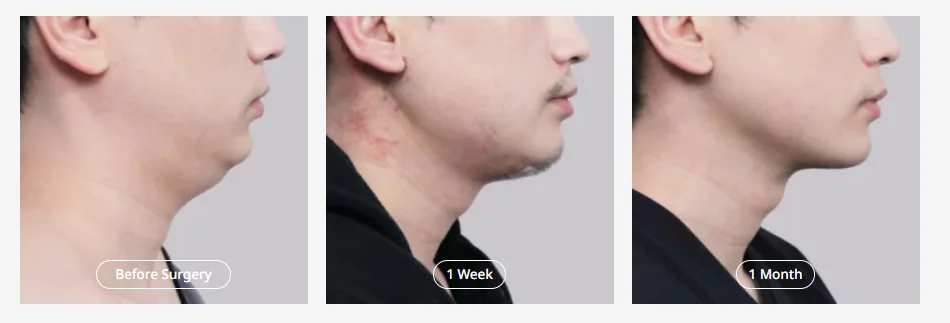 Salivary gland reduction before and after: male patient's jawline at 1 week and 1 month post-surgery at MINE Clinic Seoul.