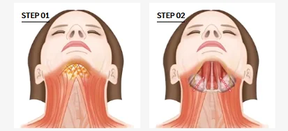 Medical illustration showing the fat layer above and the submandibular salivary glands below, explaining why liposuction alone cannot slim the jawline.