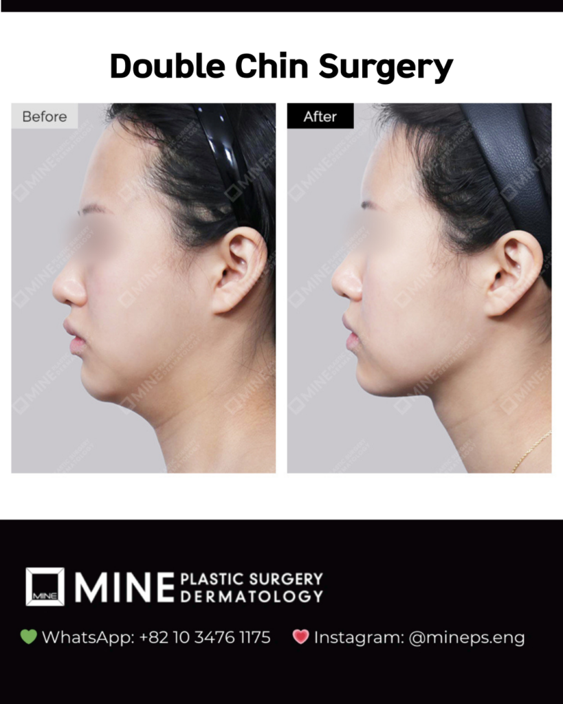 Double chin before and after — actual Mine Clinic patient, standardised side-profile photography.