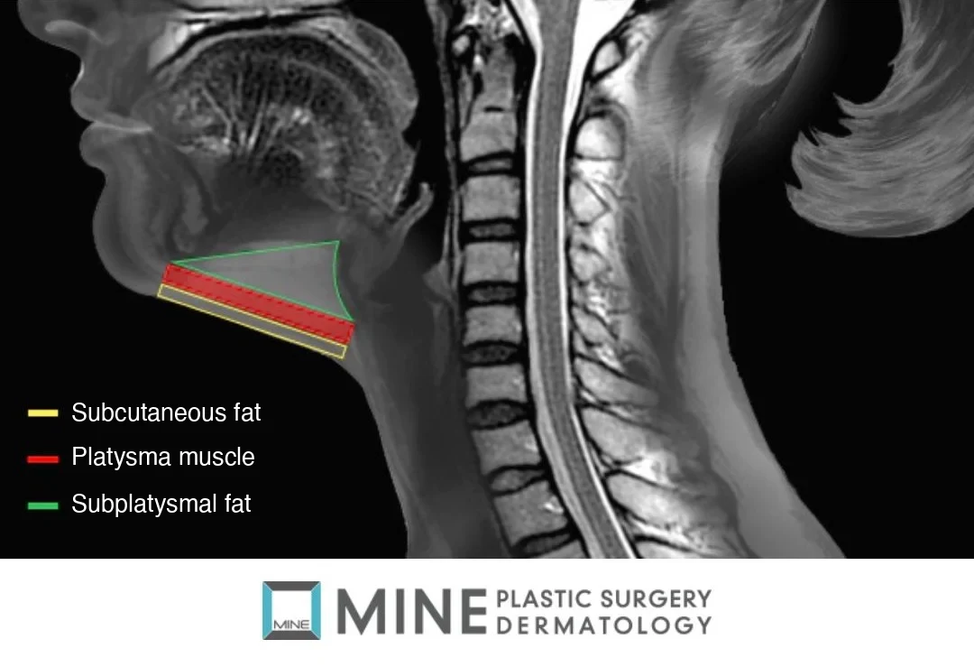 Neck MRI showing the three fat layers treated in double chin surgery: subcutaneous fat, platysma muscle, and subplatysmal fat