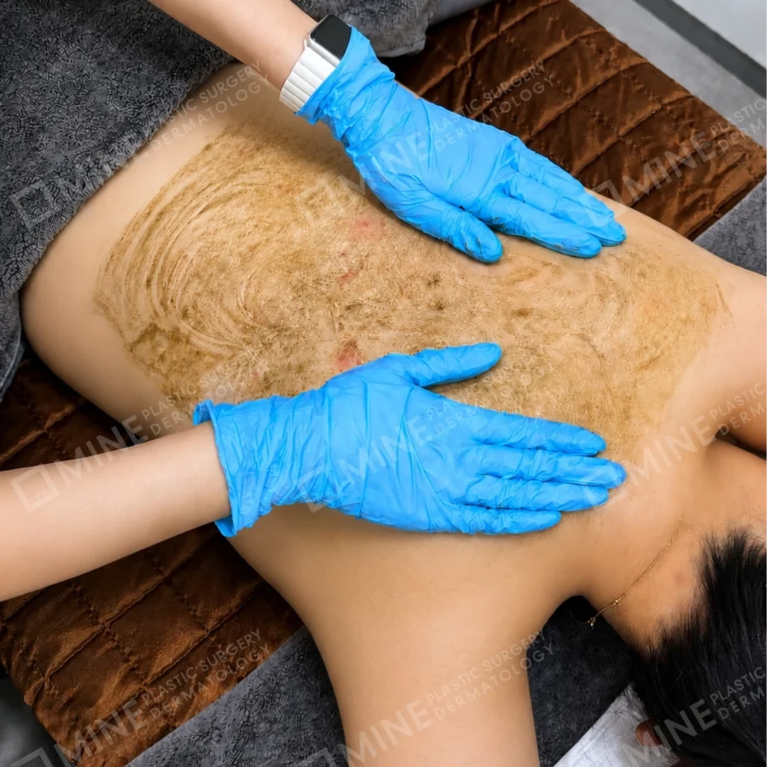 In-clinic treatment of post-acne skin at MINE in Seoul