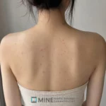 Acne marks and post-inflammatory pigmentation on a patient upper back