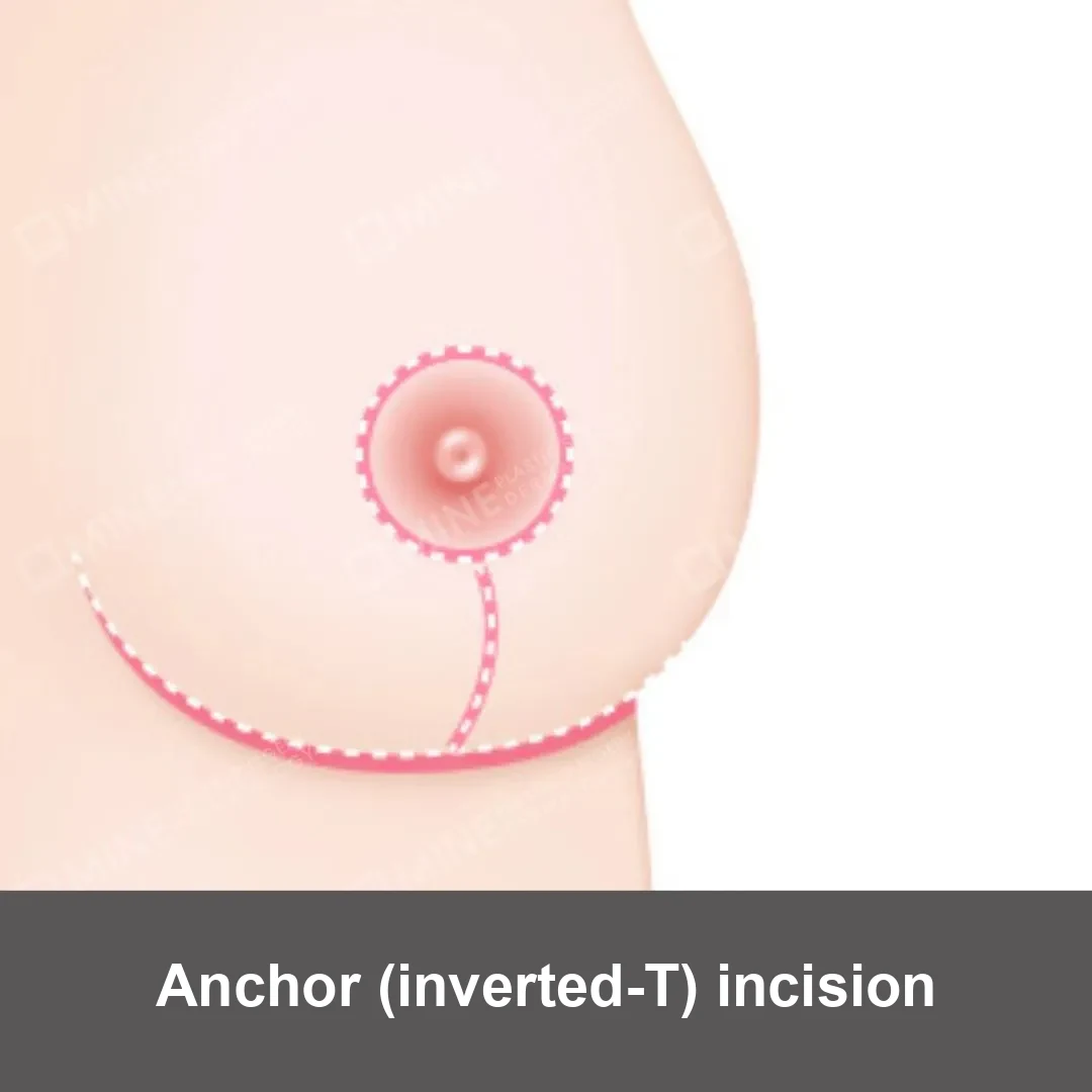 Anchor inverted-T incision pattern showing where breast lift surgery scars fall around the areola and in the breast crease.